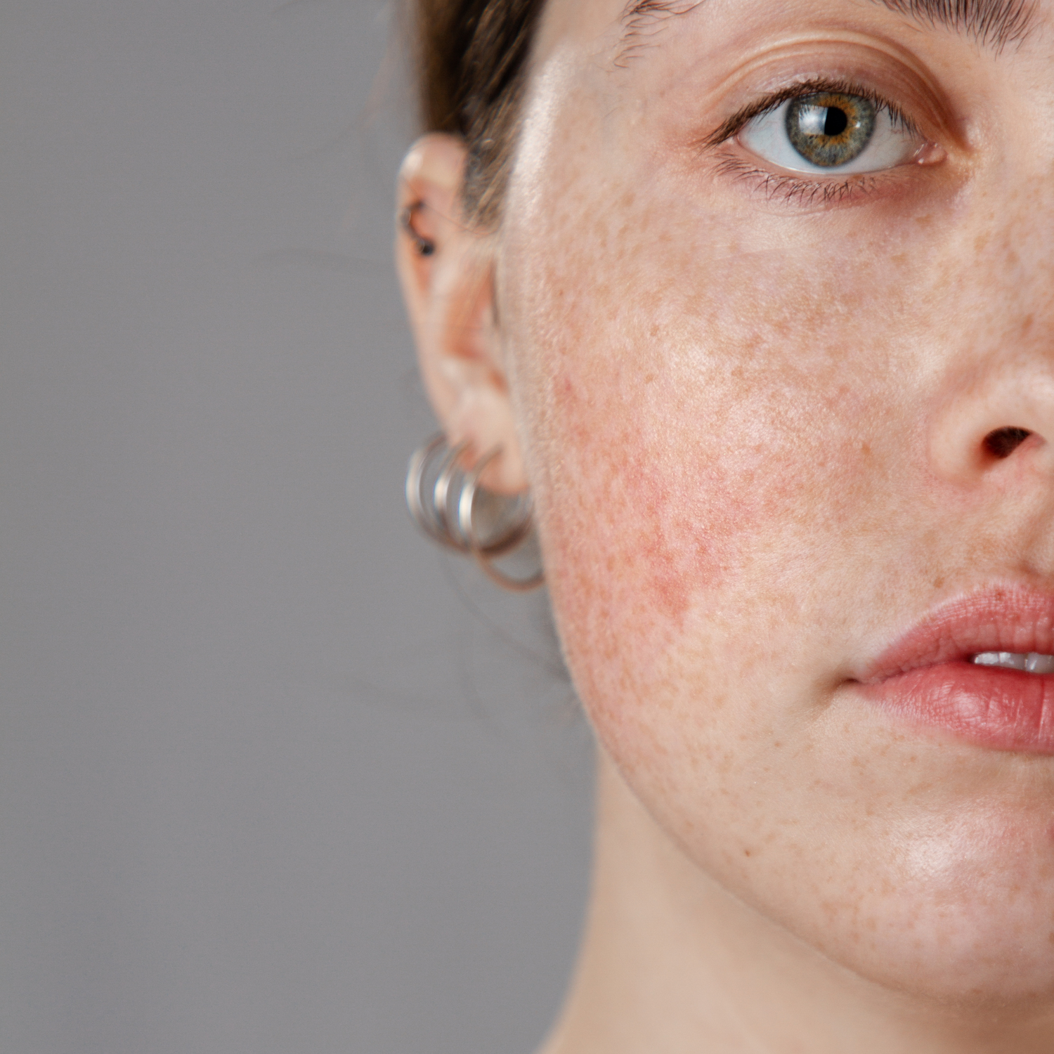 Rosacea im Gesicht - wenn das Gesicht plötzlich "glüht"