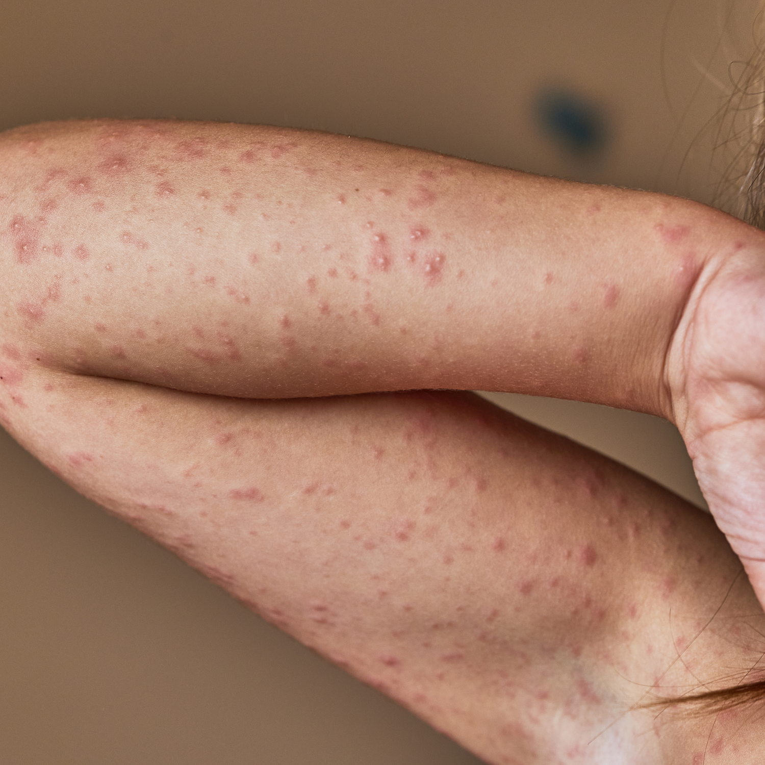 Allergische Reaktion im Gesicht: Ursachen, Symptome und was sofort hilft