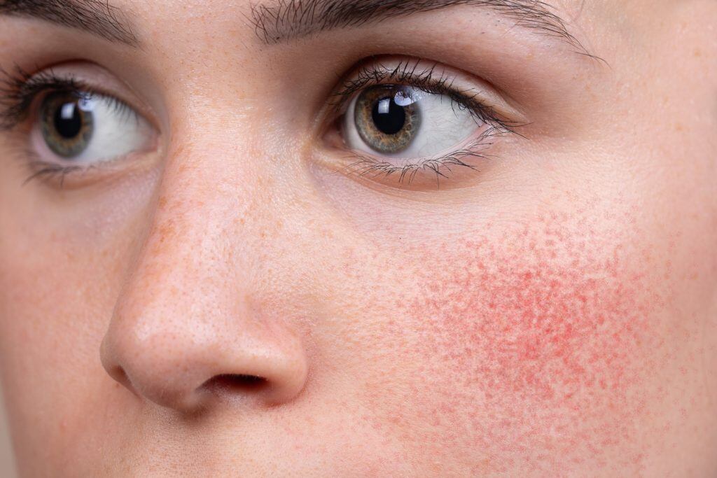 Jeder Fleck, jede Narbe und jede Rötung erzählt eine einzigartige Geschichte - Rosacea