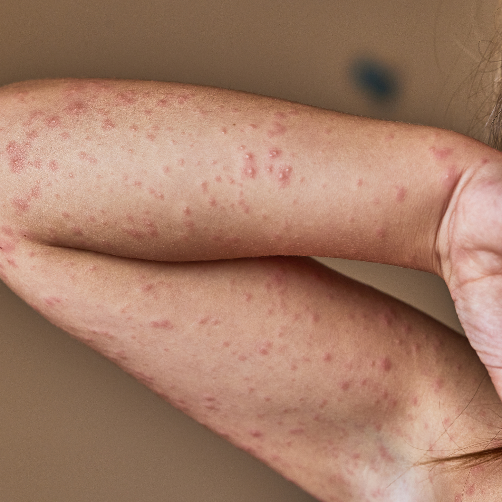 Allergische Reaktion im Gesicht: Ursachen, Symptome und was sofort hilft