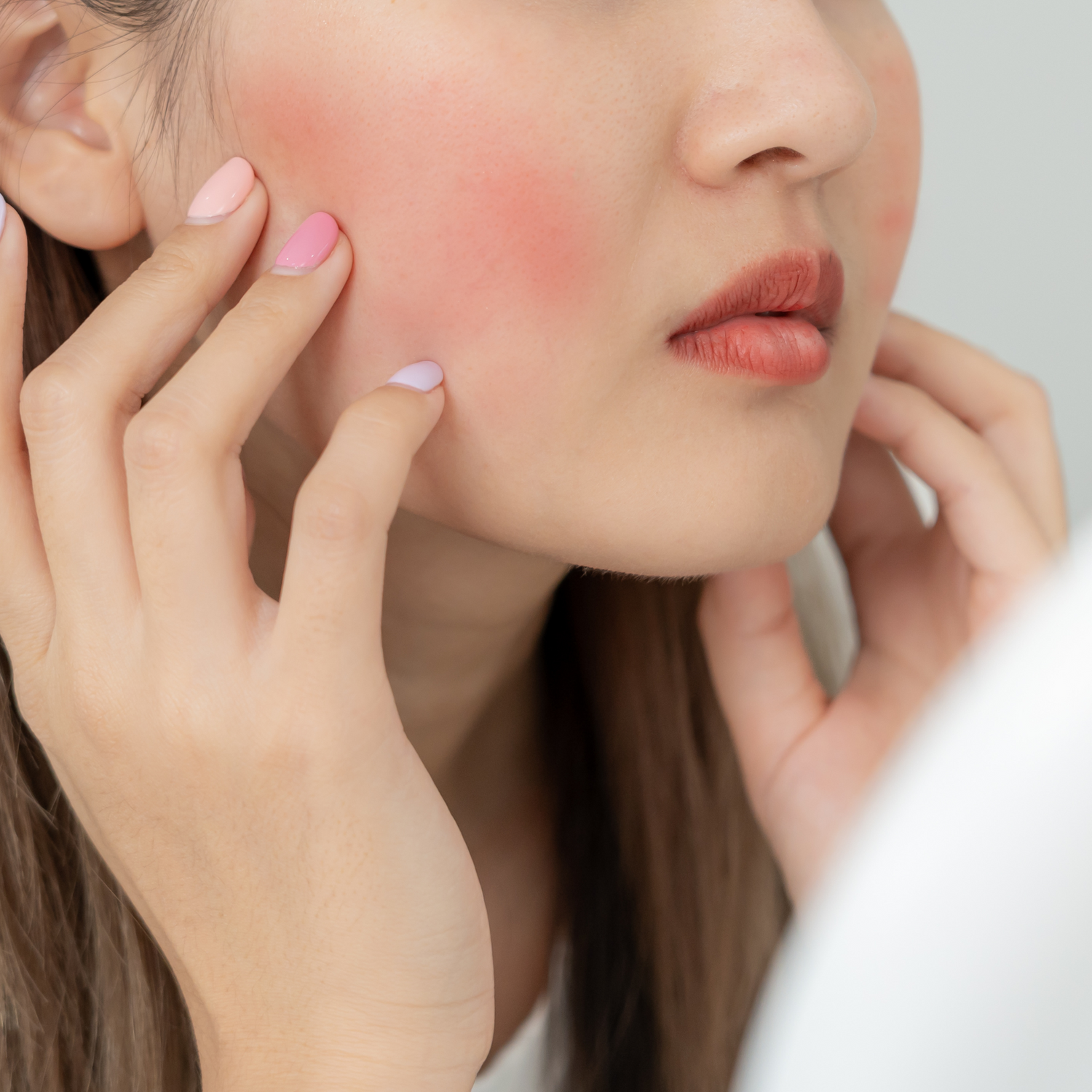 Rosacea im Gesicht - wenn das Gesicht plötzlich "glüht"