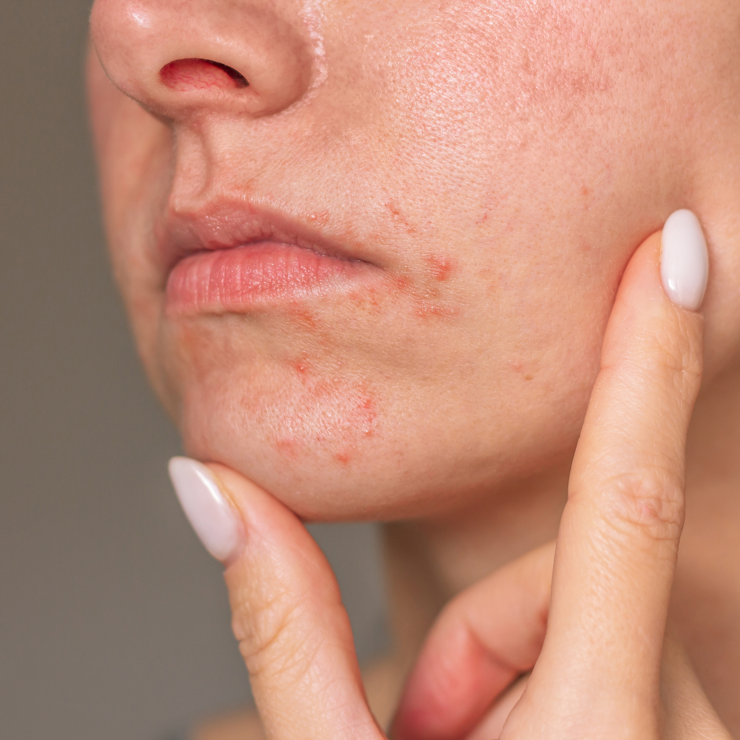 Wenn die Haut rund um den Mund rebelliert - so bekommst du periorale Dermatitis natürlich in den Griff